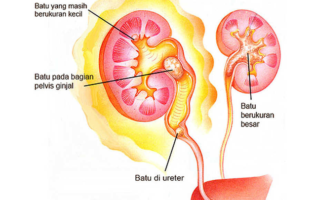 Illustration for article titled Gambar Orang Sakit Batu Ginjal
